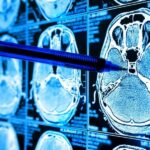 تشخیص نشانه‌های بیماری در اسکن‌های MRI با هوش مصنوعی
